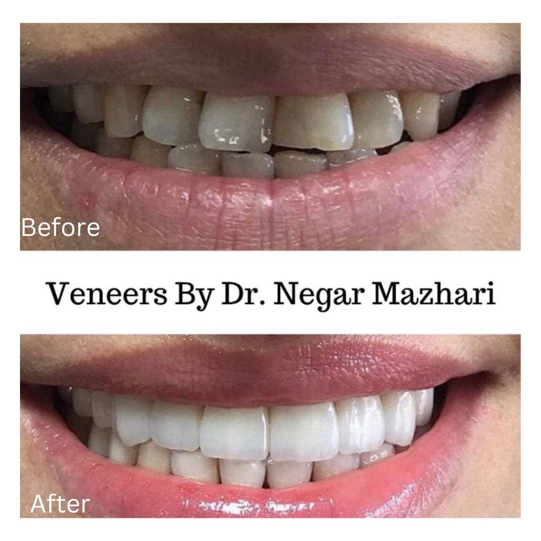 VeneersFile-8.jpg