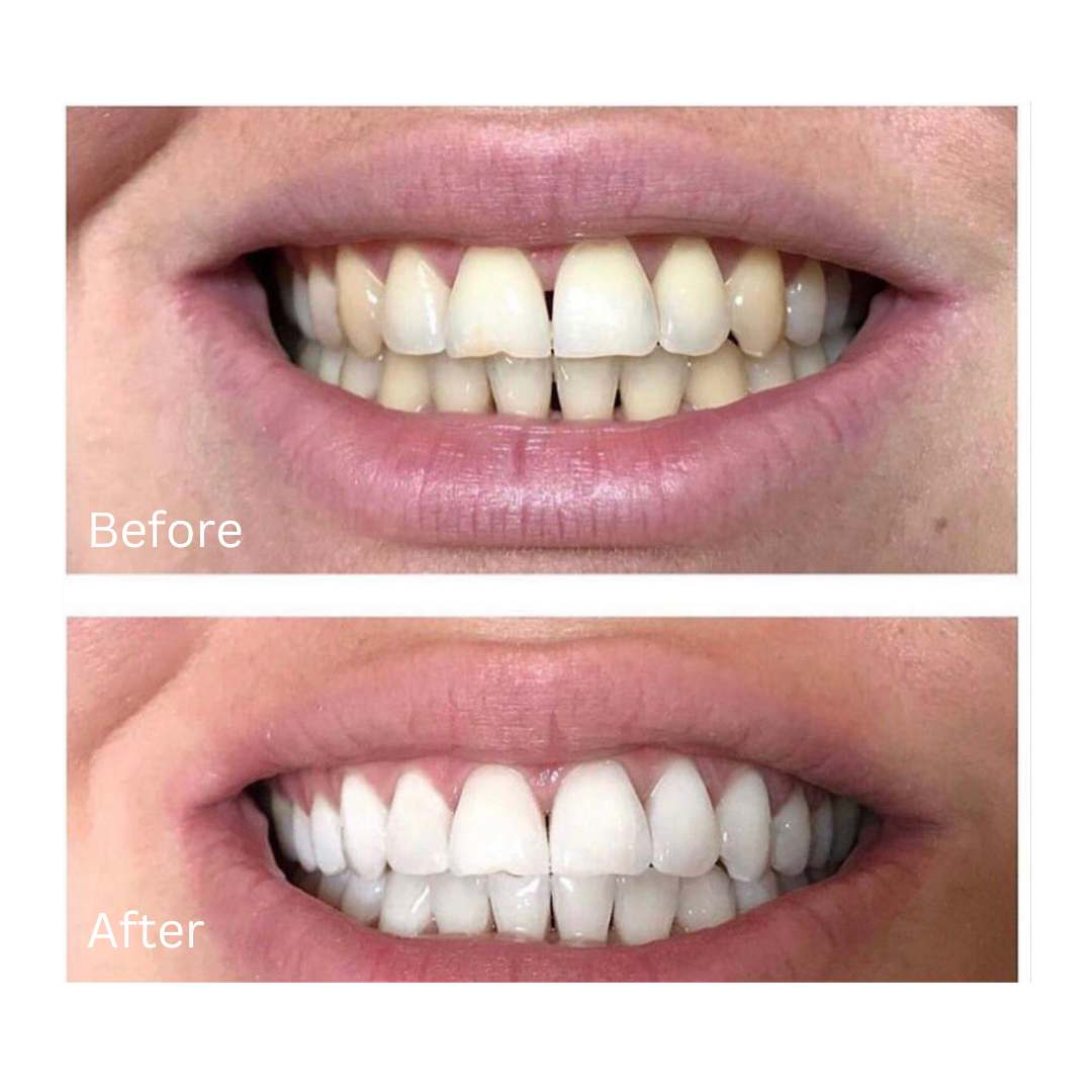 teeth-whitening1.jpg