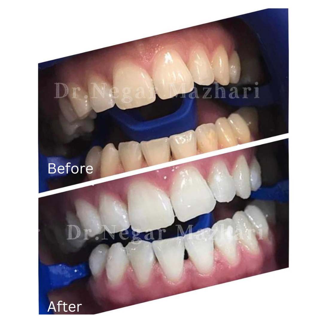teeth-whitening10.jpg