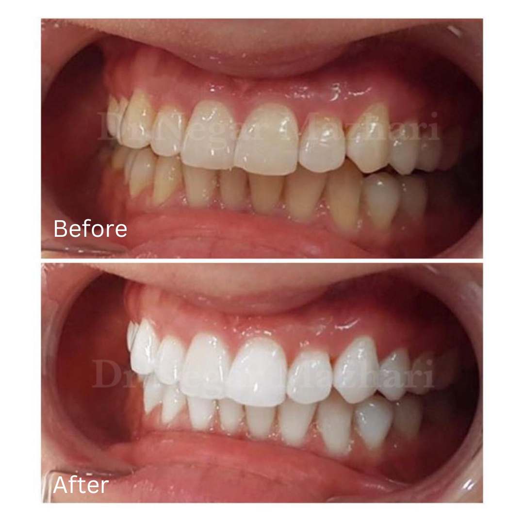 teeth-whitening11.jpg