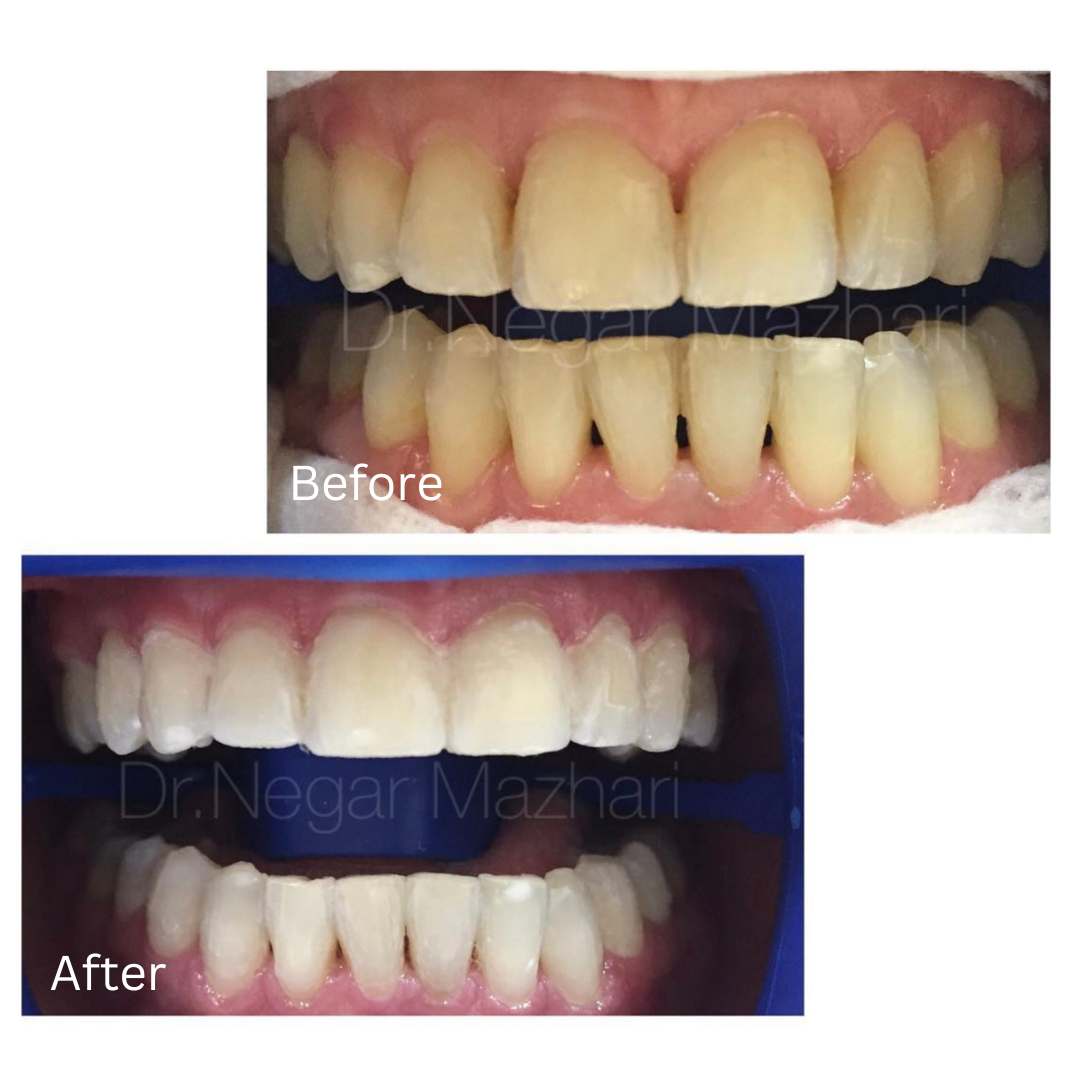 teeth-whitening12.jpg