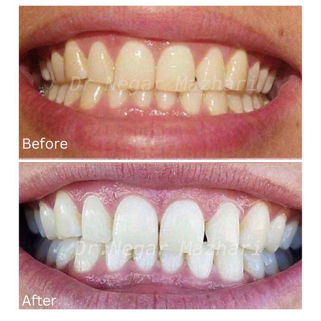 teeth-whitening13.jpg