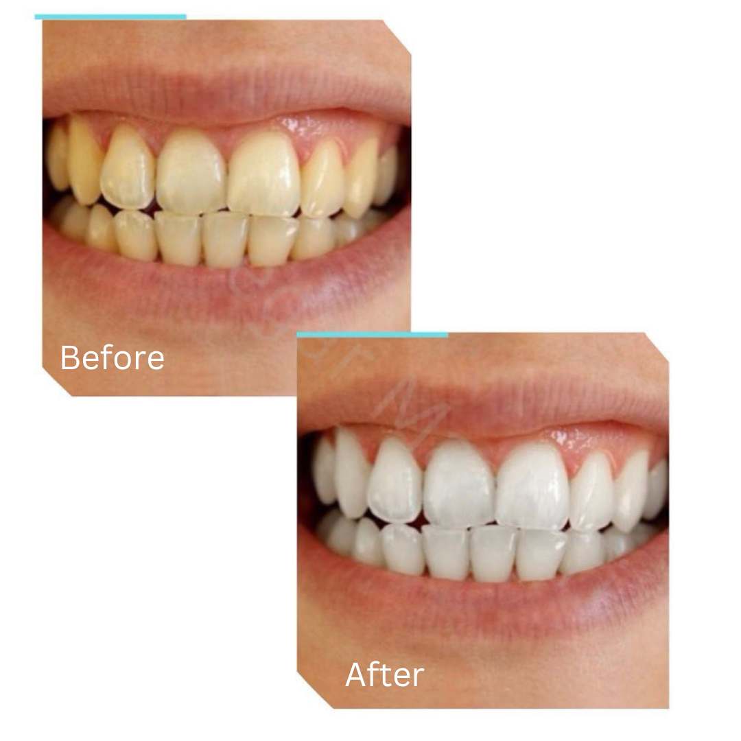teeth-whitening14.jpg