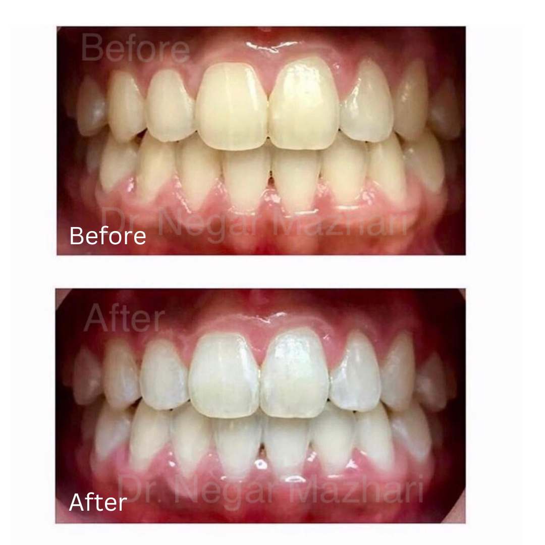 teeth-whitening15.jpg