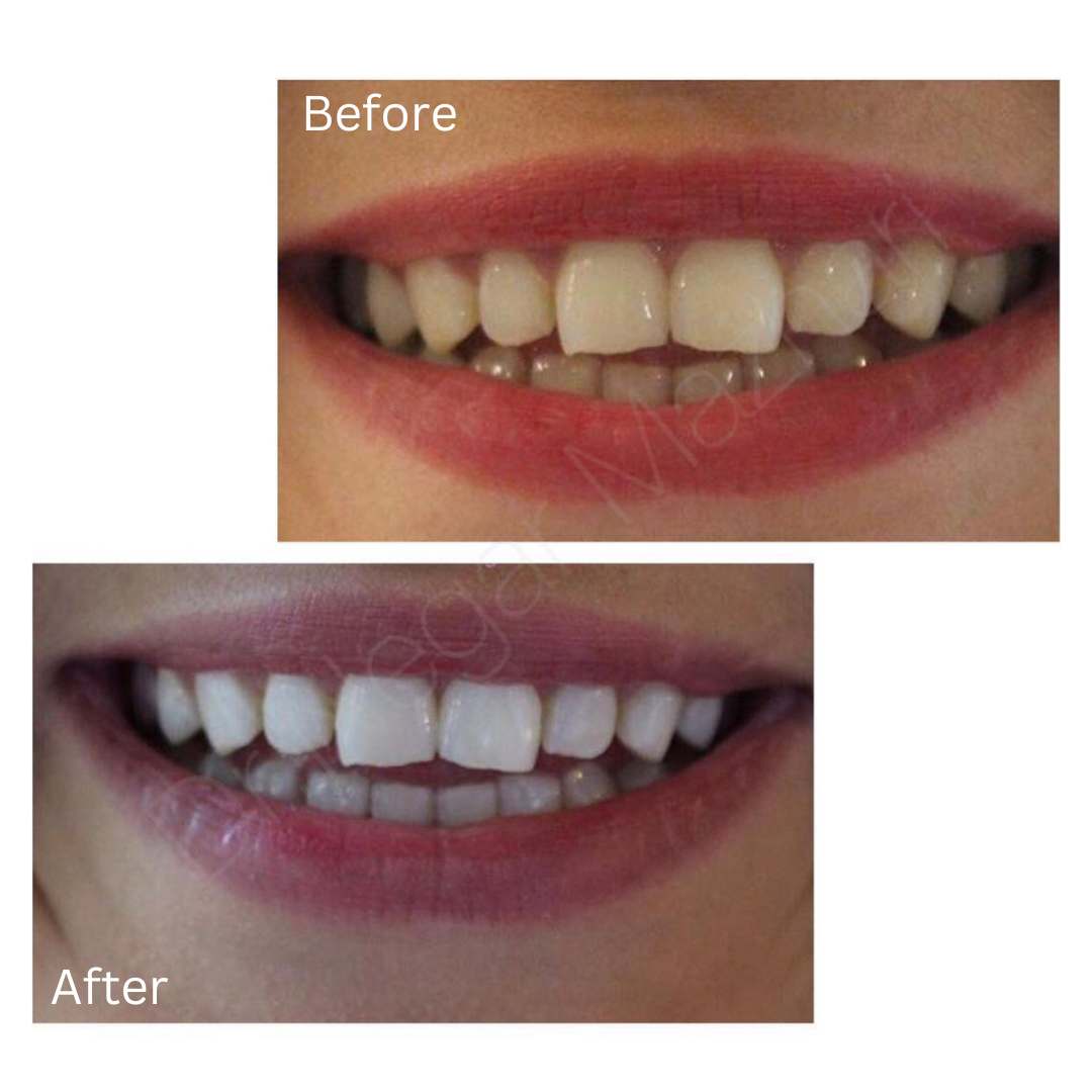 teeth-whitening16.jpg