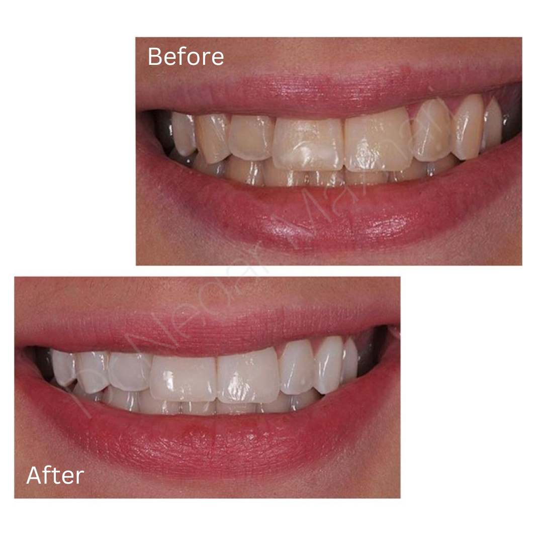 teeth-whitening17.jpg