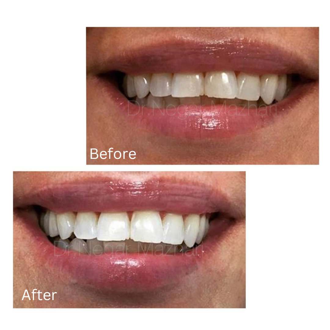 teeth-whitening18.jpg