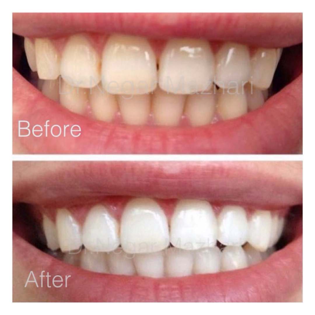 teeth-whitening19.jpg