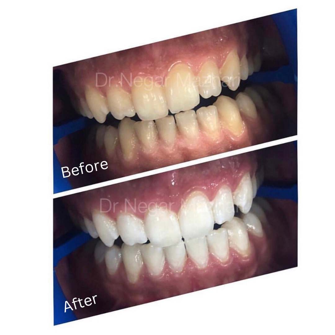 teeth-whitening2.jpg