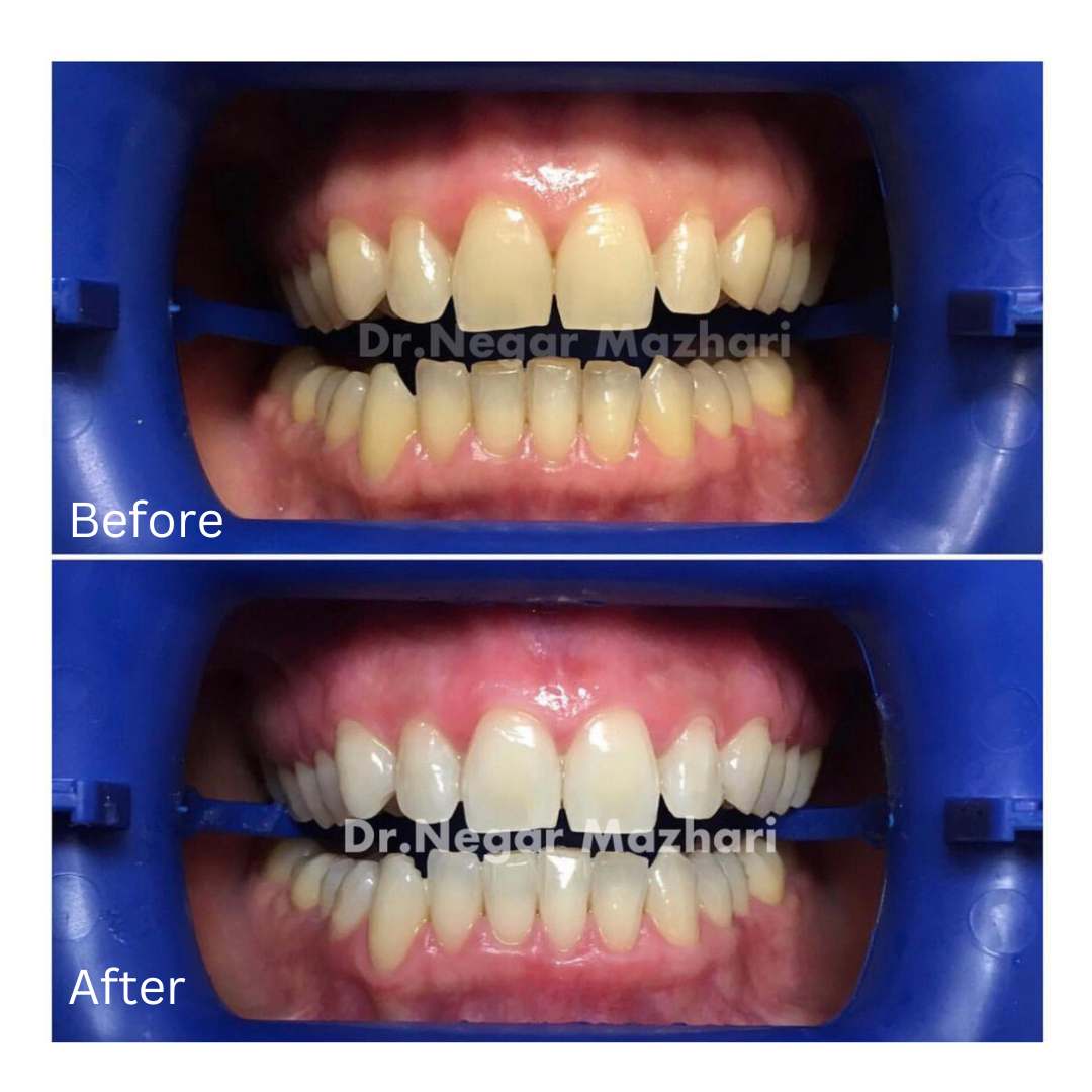 teeth-whitening3.jpg
