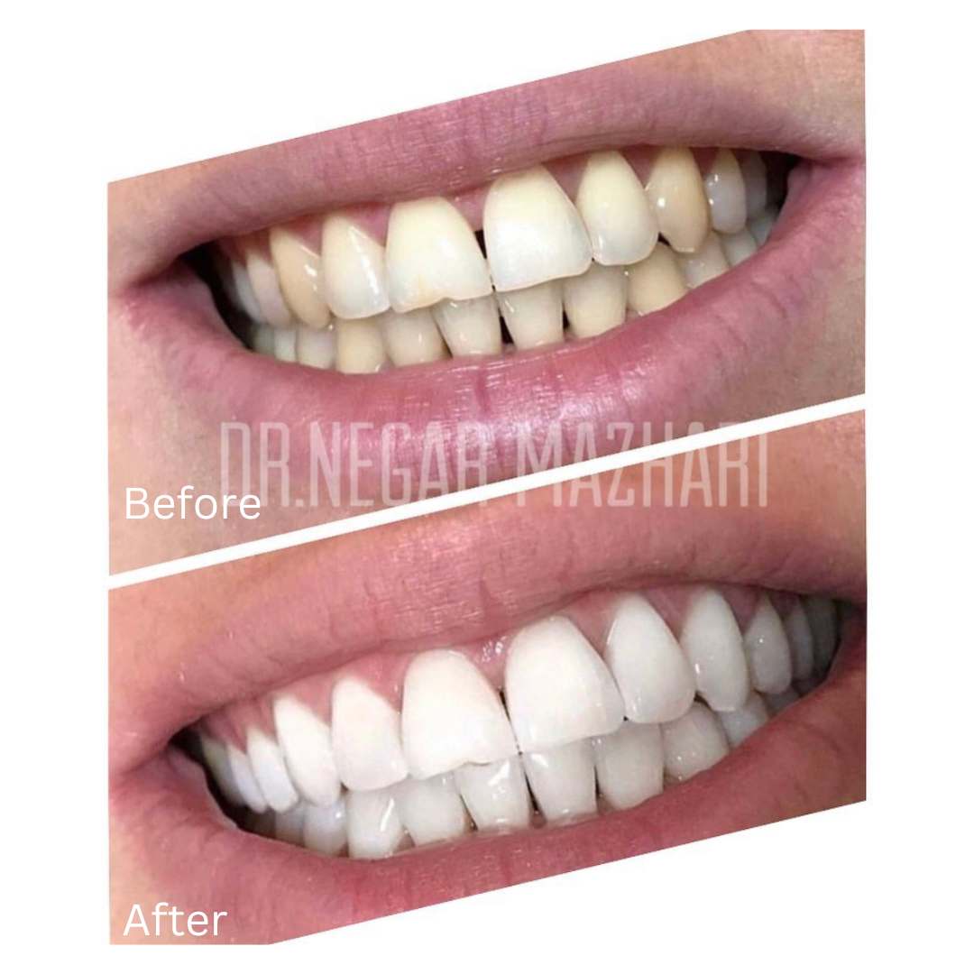 teeth-whitening4.jpg