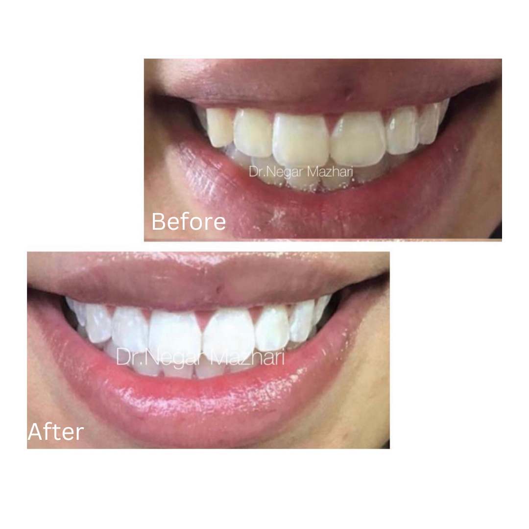 teeth-whitening5.jpg