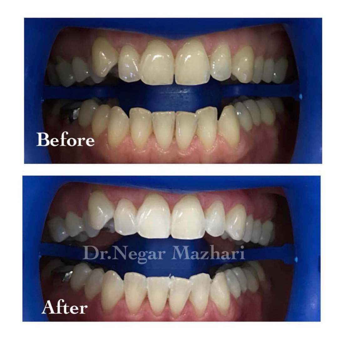 teeth-whitening6.jpg
