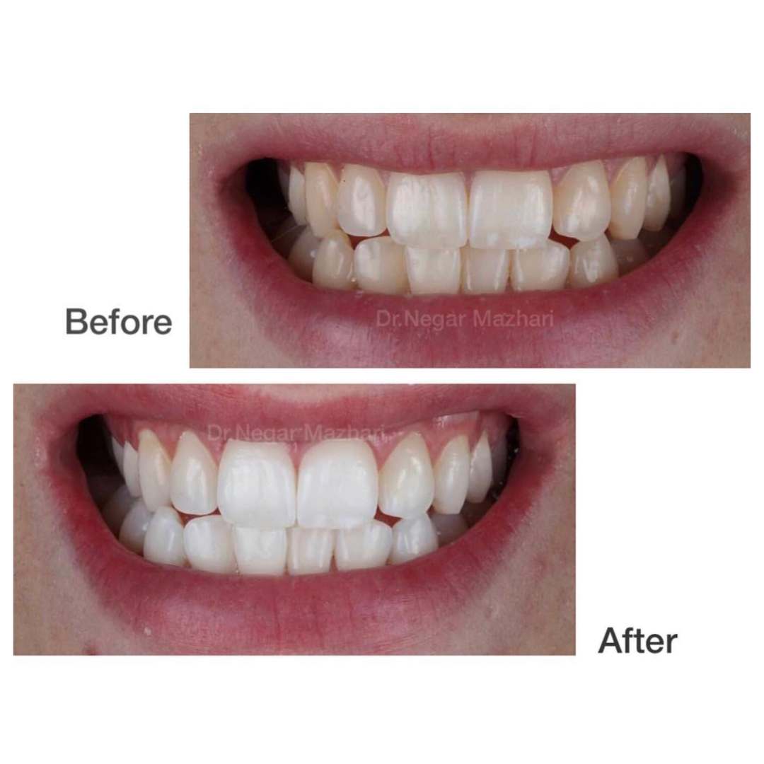 teeth-whitening7.jpg