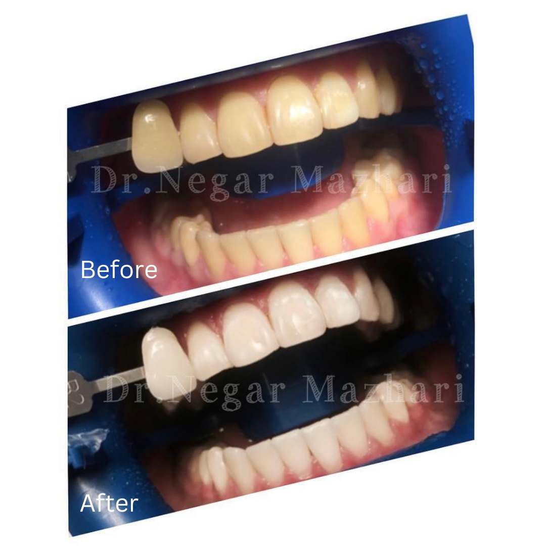 teeth-whitening8.jpg