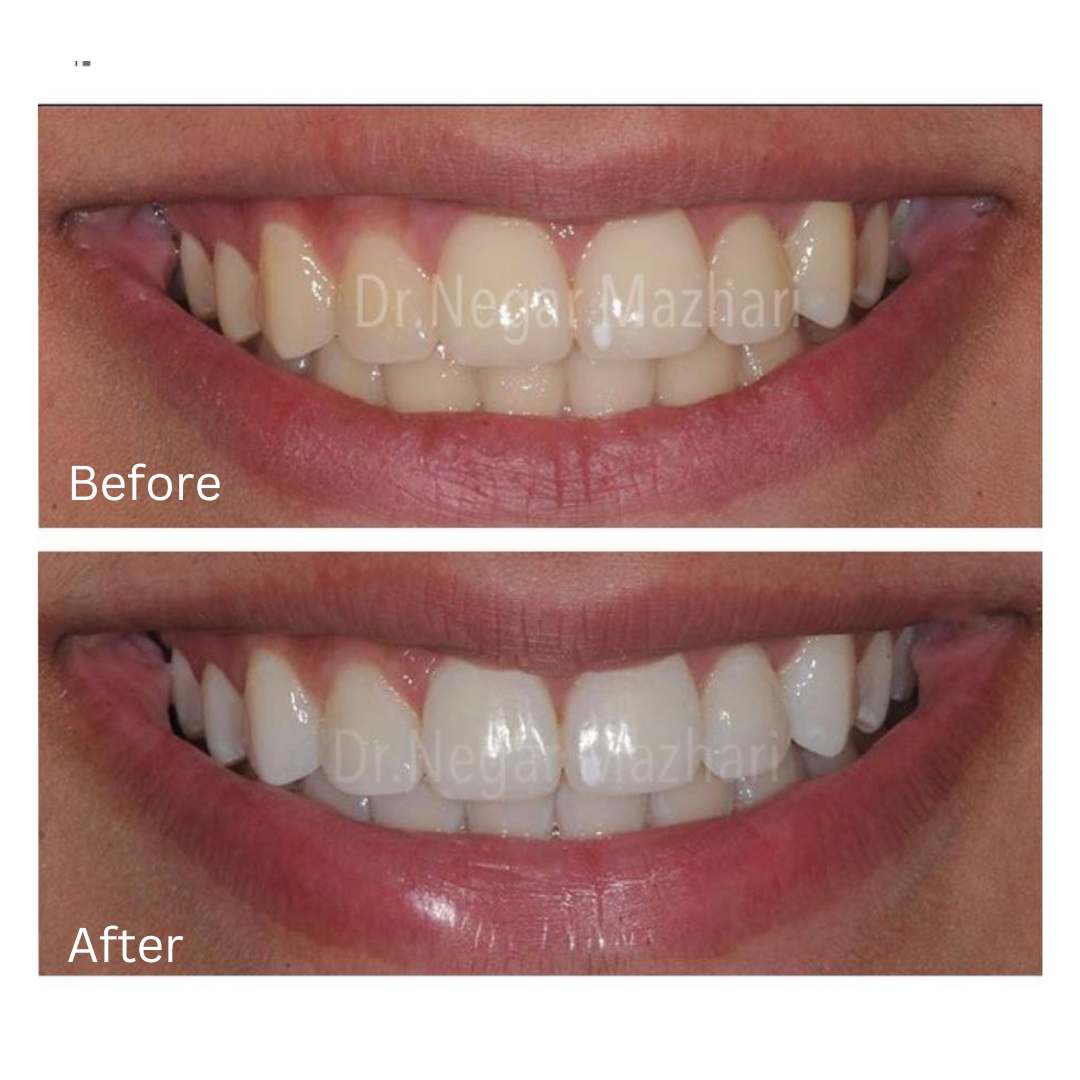 teeth-whitening9.jpg
